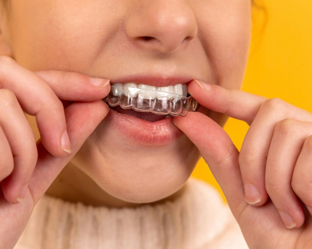 Close-up of a person placing a clear aligner tray over their teeth